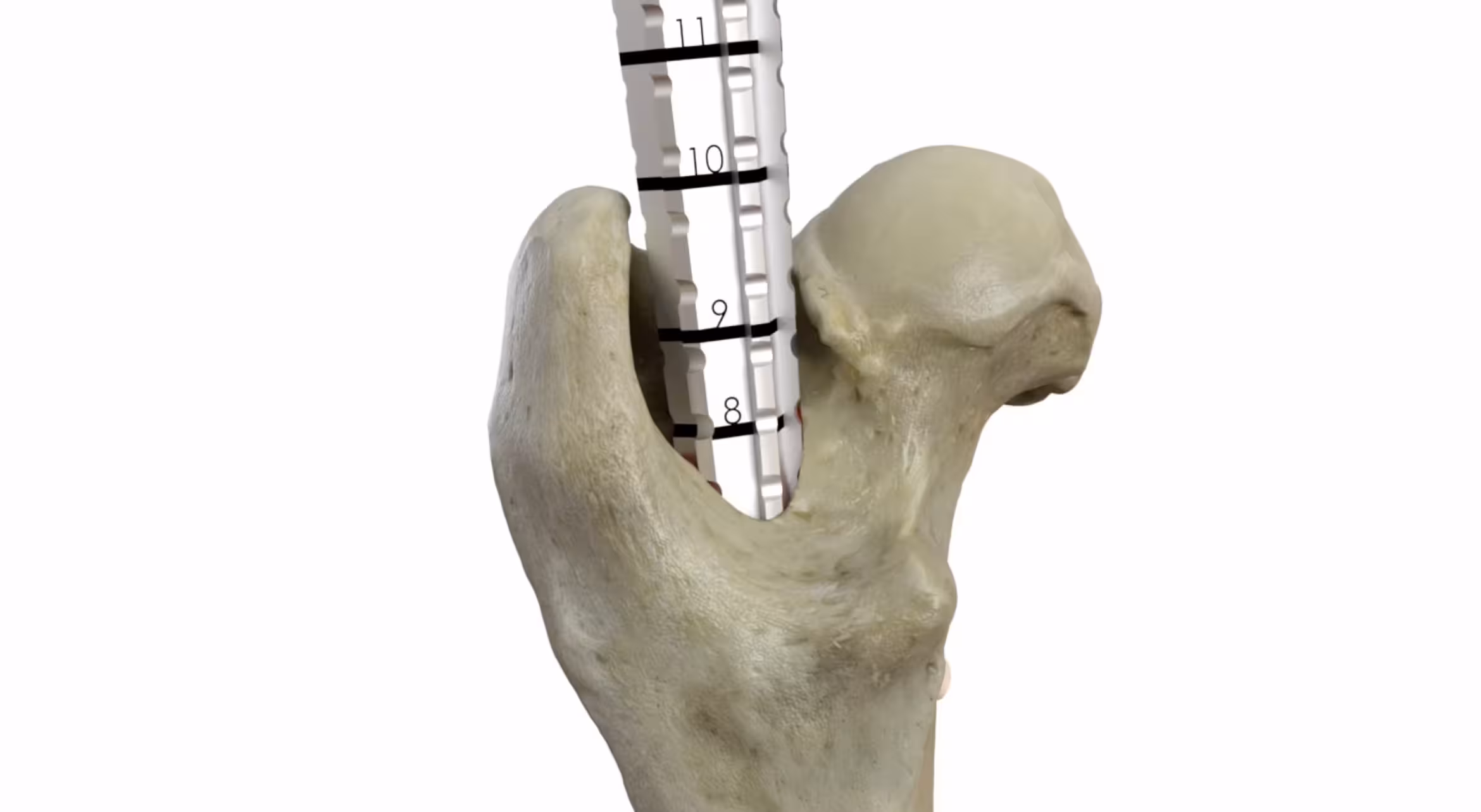3D rendering of a hip bone with an implanted metal orthopedic component inserted into the femur.